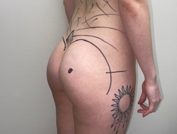 Butt Lift Before & After Gallery - Patient 46630304 - Image 3