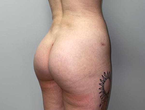 Butt Lift Before & After Gallery - Patient 46630304 - Image 4