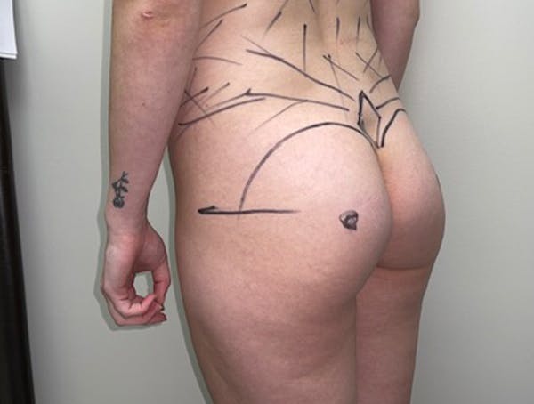 Butt Lift Before & After Gallery - Patient 46630304 - Image 5