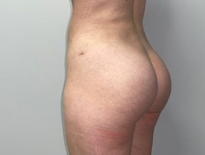 Butt Lift Before & After Gallery - Patient 46630304 - Image 6
