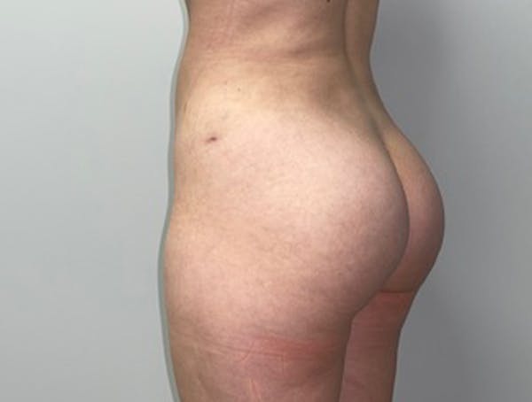 Butt Lift Before & After Gallery - Patient 46630304 - Image 6