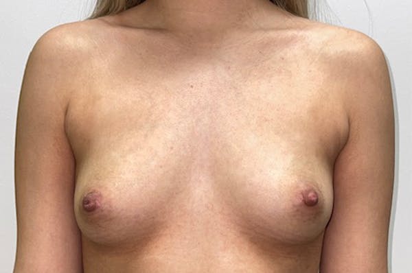 Breast Augmentation Before & After Gallery - Patient 46630381 - Image 1