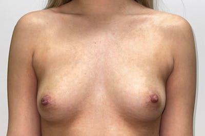 Breast Augmentation Before & After Gallery - Patient 46630381 - Image 1