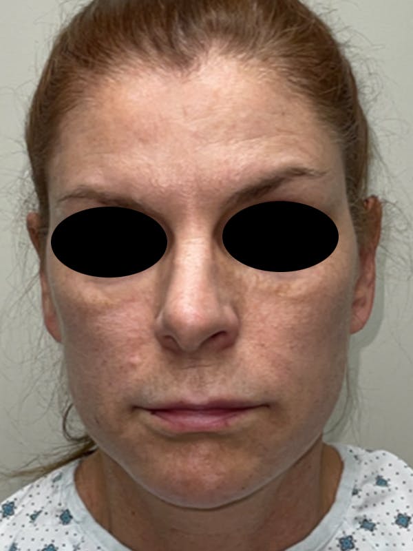 Facial Fat Transfer Before & After Gallery - Patient 46629753 - Image 1