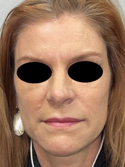 Facial Fat Transfer Before & After Gallery - Patient 46629753 - Image 2