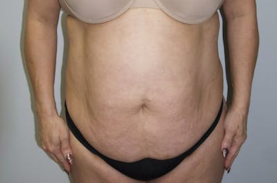 Liposuction Before & After Gallery - Patient 47434518 - Image 1