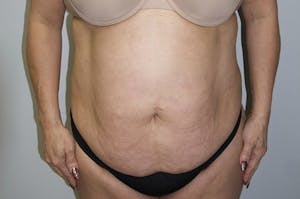 Before and after Liposuction in Houston, TX 1