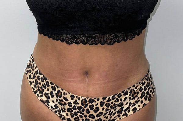 Before and after Liposuction in Houston, TX 1