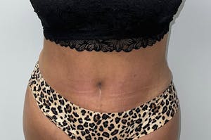 Before & After Body Contouring in Houston