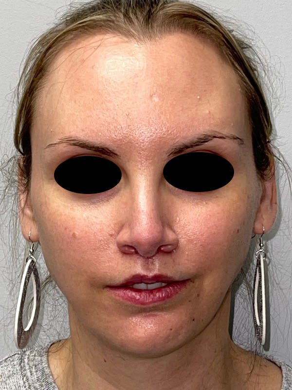 Facial Fat Transfer Gallery - Patient 47434643 - Image 2