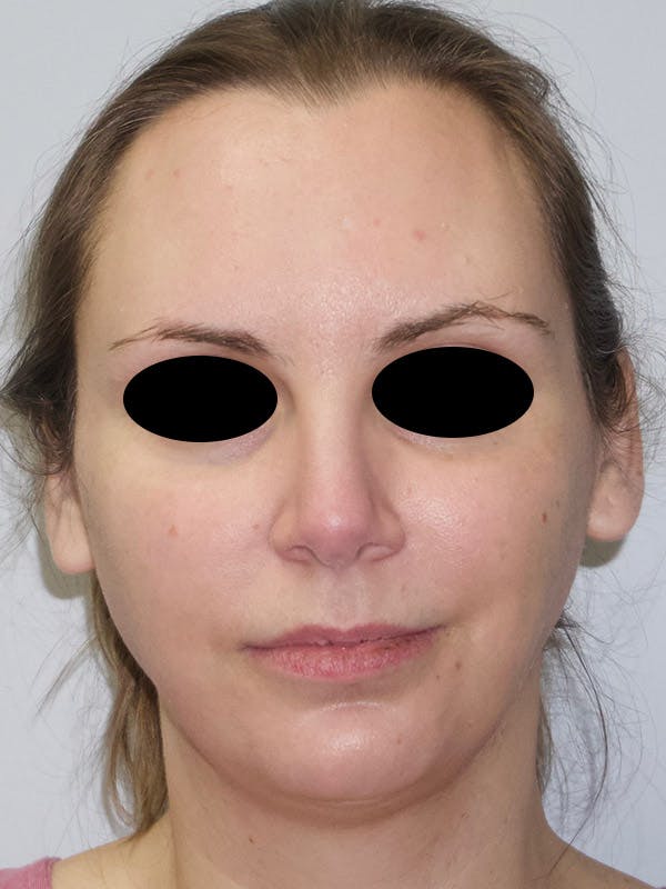 Facial Fat Transfer Before & After Gallery - Patient 47434643 - Image 1