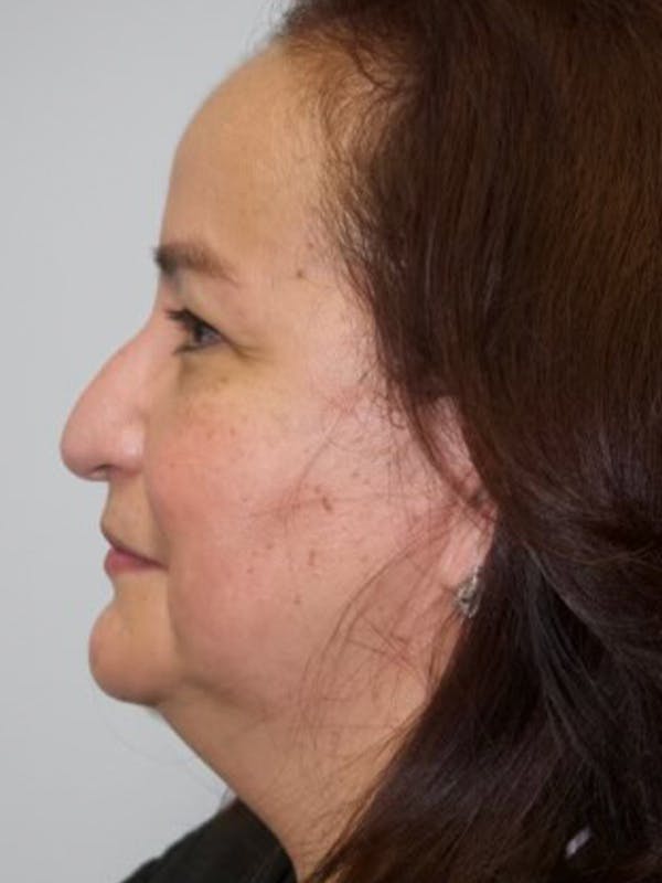 Facelift Before & After Gallery - Patient 144198029 - Image 5