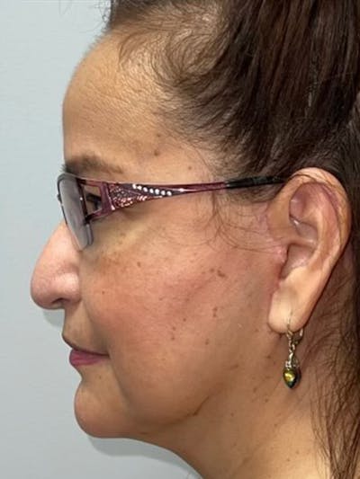 Facelift Before & After Gallery - Patient 144198029 - Image 6