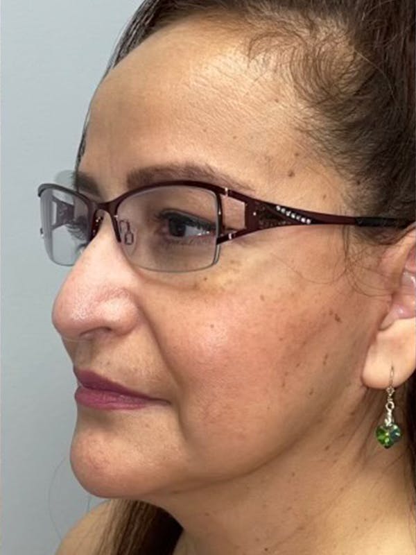 Facelift Before & After Gallery - Patient 144198029 - Image 4