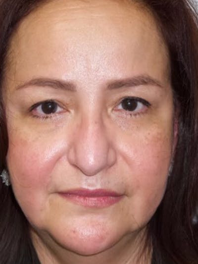 Facelift Before & After Gallery - Patient 144198029 - Image 1