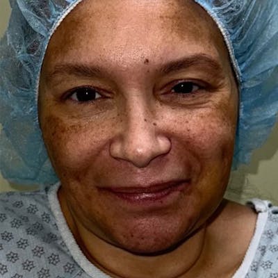 Facelift Before & After Gallery - Patient 144198030 - Image 1