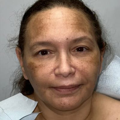 Facelift Before & After Gallery - Patient 144198030 - Image 2