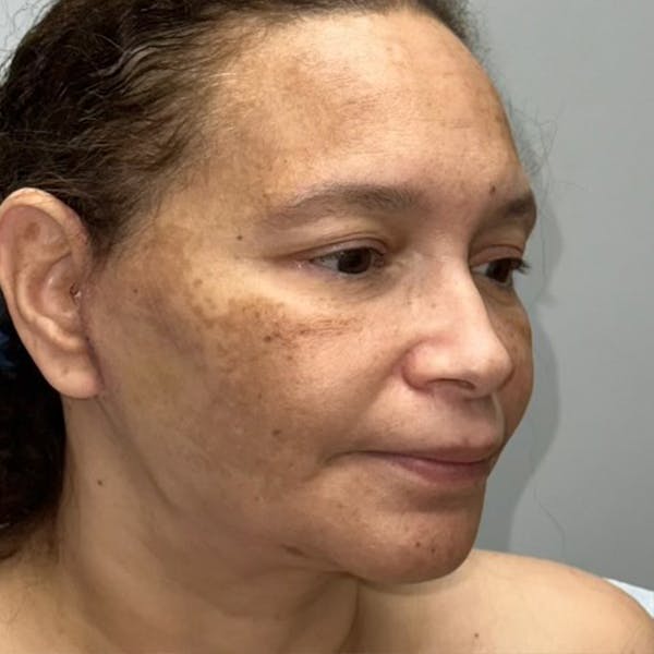 Facelift Before & After Gallery - Patient 144198030 - Image 4