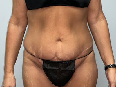 Tummy Tuck Before & After Gallery - Patient 115157 - Image 1