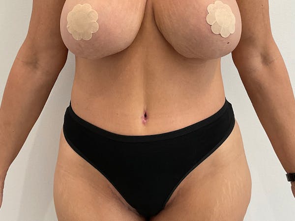 Liposuction Before & After Gallery - Patient 360318 - Image 2