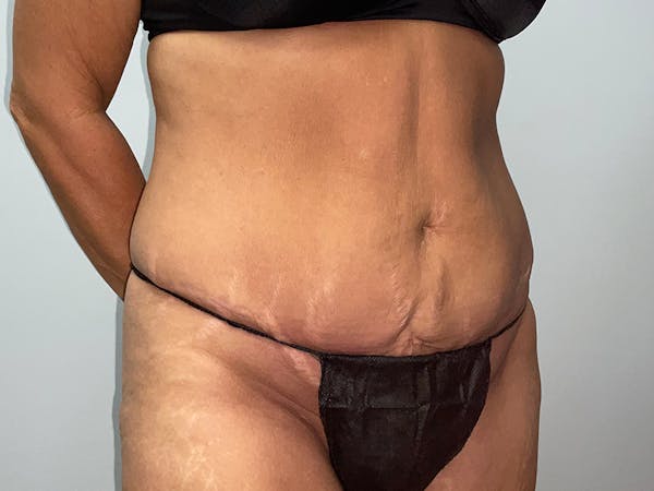Tummy Tuck Before & After Gallery - Patient 115157 - Image 3
