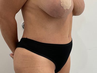 Tummy Tuck Before & After Gallery - Patient 115157 - Image 4