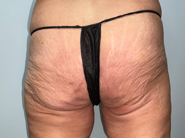 Butt Lift Before & After Gallery - Patient 391006 - Image 1