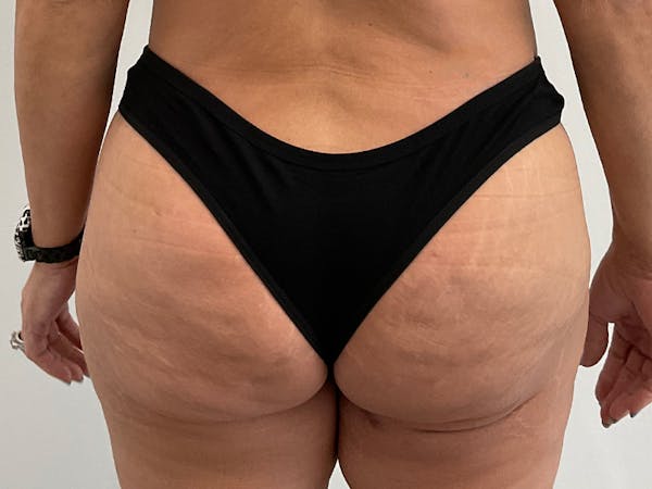 Butt Lift Before & After Gallery - Patient 391006 - Image 2