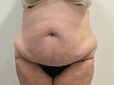 Liposuction Before & After Gallery - Patient 251695 - Image 1