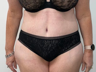 Tummy Tuck Before & After Gallery - Patient 856732 - Image 2