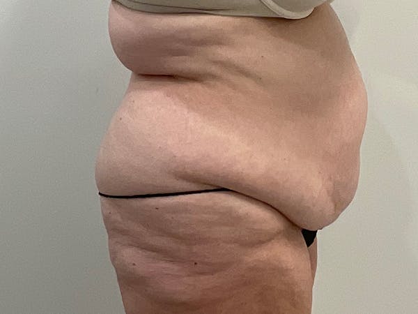 Liposuction Before & After Gallery - Patient 251695 - Image 3