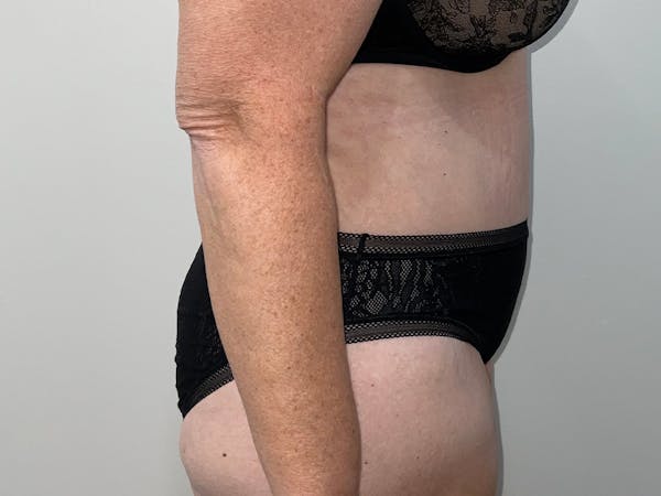 Tummy Tuck Before & After Gallery - Patient 856732 - Image 4