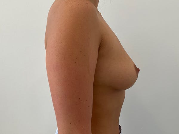 Breast Augmentation Before & After Gallery - Patient 746476 - Image 5