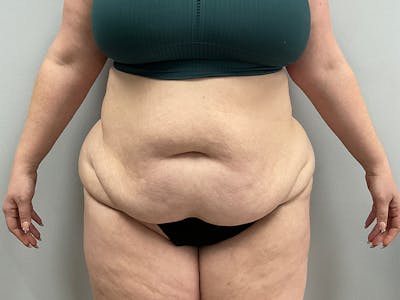 Tummy Tuck Before & After Gallery - Patient 120470 - Image 1