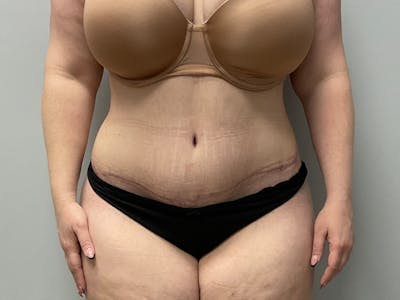 Tummy Tuck Before & After Gallery - Patient 120470 - Image 2
