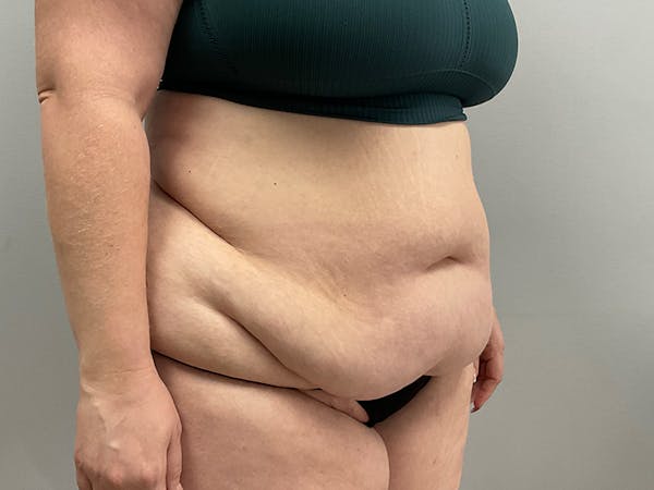 Liposuction Before & After Gallery - Patient 392516 - Image 3