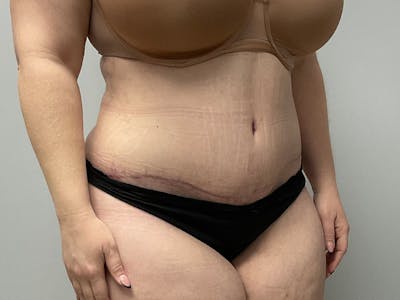Liposuction Before & After Gallery - Patient 392516 - Image 4