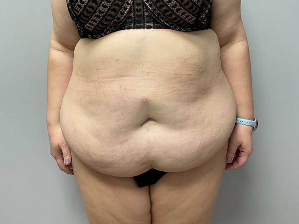 Liposuction Before & After Gallery - Patient 360207 - Image 1
