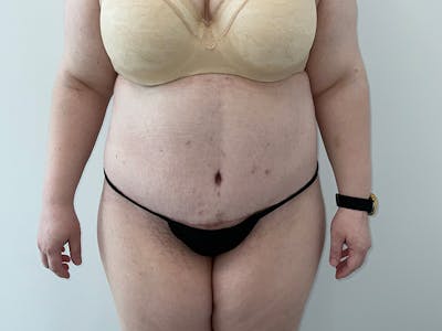 Liposuction Before & After Gallery - Patient 360207 - Image 2