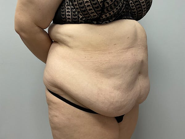 Tummy Tuck Before & After Gallery - Patient 426639 - Image 3