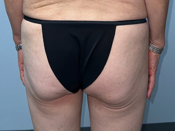 Butt Lift Before & After Gallery - Patient 328389 - Image 1