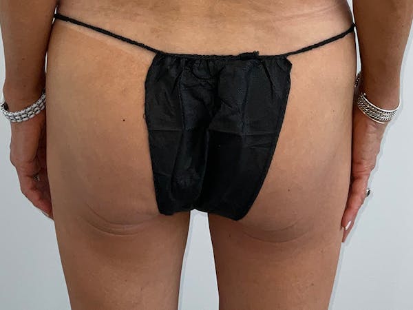 Butt Lift Before & After Gallery - Patient 328389 - Image 2