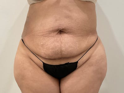 Liposuction Before & After Gallery - Patient 360916 - Image 1