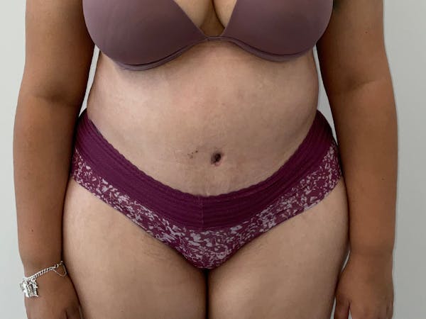 Liposuction Before & After Gallery - Patient 360916 - Image 2