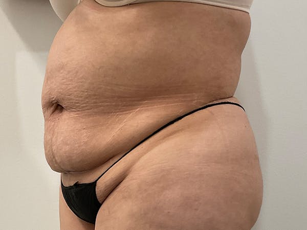 Tummy Tuck Before & After Gallery - Patient 227650 - Image 3