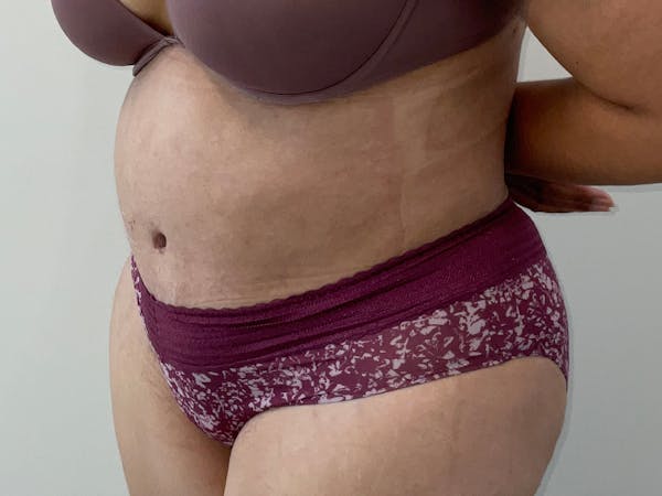 Liposuction Before & After Gallery - Patient 360916 - Image 4