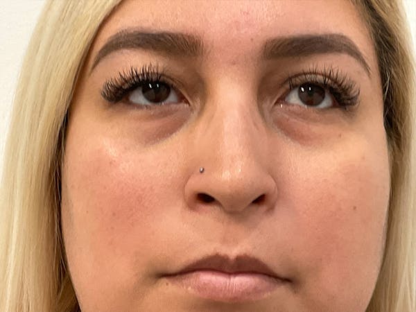 Rhinoplasty Before & After Gallery - Patient 551241 - Image 1