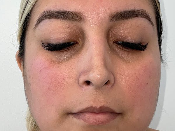 Rhinoplasty Before & After Gallery - Patient 551241 - Image 2