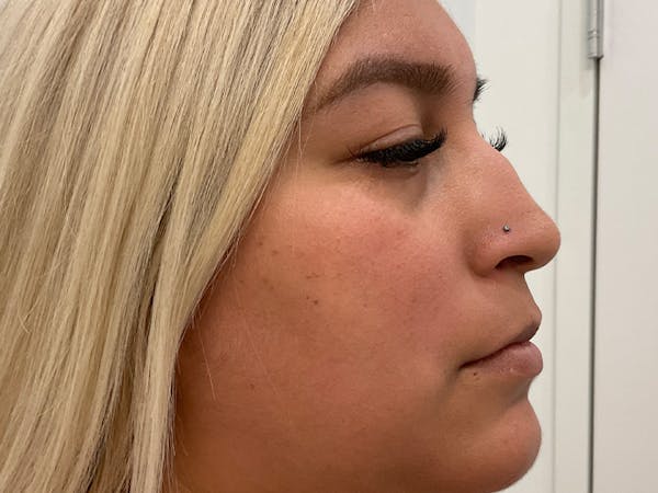 Rhinoplasty Before & After Gallery - Patient 551241 - Image 3