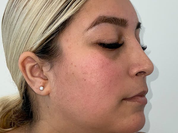 Rhinoplasty Before & After Gallery - Patient 551241 - Image 4